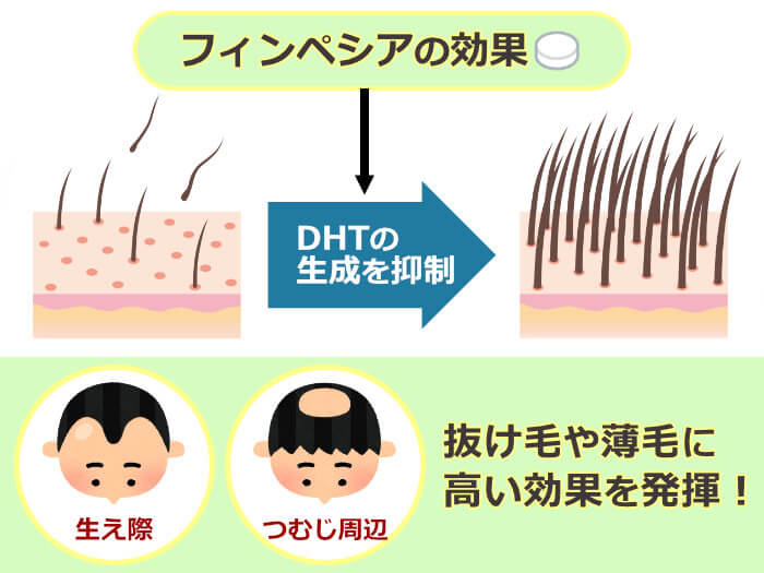 フィンペシアの効果とは？効果が出るまでの期間についても徹底解説