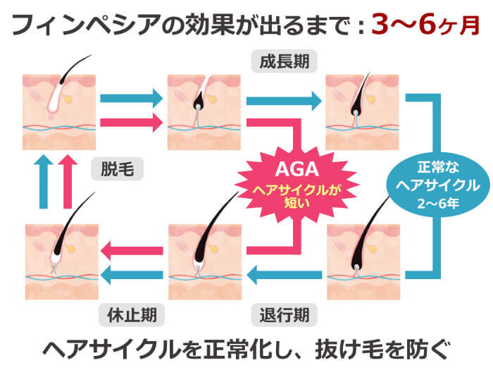 フィンペシアの効果が出るまでの期間