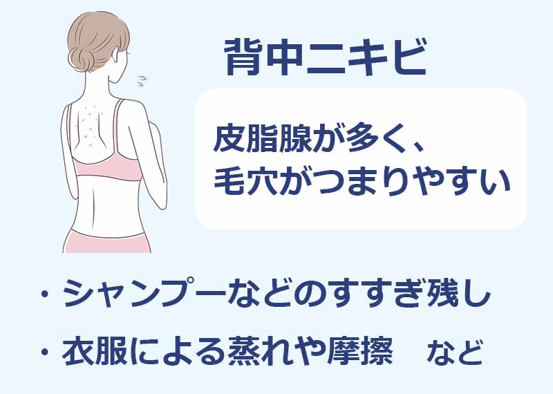 背中ニキビ,皮脂腺が多く毛穴がつまりやすい,シャンプーなどのすすぎ残し,衣服による蒸れや摩擦など