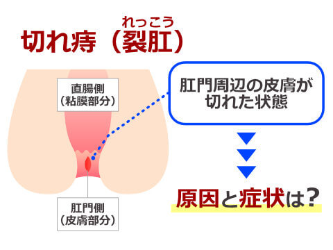 痔瘻 コレクション 石鹸